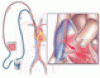 Extracorporeal membrane oxygenation in adults: A practical guide for internists