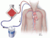 On the horizon: Extracorporeal carbon dioxide removal