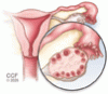 Polycystic ovary syndrome: An update on diagnosis and management