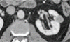 Small renal masses: Toward more rational treatment