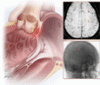 Cerebrovascular complications in infective endocarditis: Challenges and considerations in management