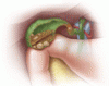 Gallstones: Watch and wait, or intervene?