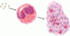 Eosinophilic esophagitis: An increasingly recognized cause of dysphagia, food impaction, and refractory heartburn