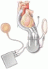 Mechanical treatment of heart failure: The growing role of LVADs and artificial hearts