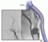 Chronic venous outflow obstruction: An important cause of chronic venous disease