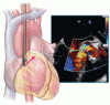Imaging to evaluate suspected infective endocarditis