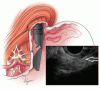 Endoscopic ultrasonography: An inside view