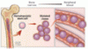 Clonal hematopoiesis of indeterminate potential and heart disease: What every internist needs to know