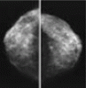 How should we screen for breast cancer? Mammography, ultrasonography, MRI