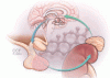 Glucocorticoid-induced adrenal insufficiency and glucocorticoid withdrawal syndrome: Two sides of the same coin