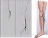A man with chronic limb-threatening ischemia and no revascularization options: Can we save his foot?