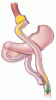 Bariatric surgery for type 2 diabetes: Weighing the impact for obese patients