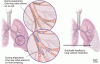 Bronchoscopic lung volume reduction with valves: What should the internist know?