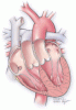 Pregnancy in a woman with congenitally corrected transposition of the great arteries