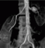 Recognizing and managing fibromuscular dysplasia