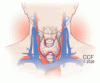 Treatment-refractory hypothyroidism: Don’t just increase the dose