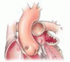 Left atrial appendage closure: An emerging option in atrial fibrillation when oral anticoagulants are not tolerated