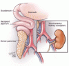 Pancreas transplant for diabetes mellitus