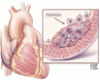 Low-dose colchicine for management of coronary artery disease