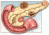 Diagnosis and management of pancreatic cystic lesions for the non-gastroenterologist