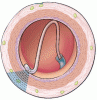 Renal denervation to treat resistant hypertension: Guarded optimism