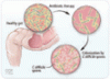Fecal microbiota transplantation: Current evidence and future directions