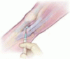 Intra-articular injections for osteoarthritis of the knee