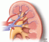 Extraosseous calcification in kidney disease