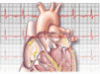 Atrial fibrillation: Rate control or rhythm control?