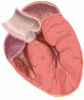 Left ventricular hypertrophy: An overlooked cardiovascular risk factor