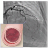 Spontaneous coronary artery dissection: An often unrecognized cause of acute coronary syndrome