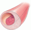 New insights into ischemic heart disease in women