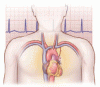 Anticoagulation management of post-cardiac surgery new-onset atrial fibrillation