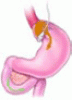 Risks and benefits of bariatric surgery: Current evidence