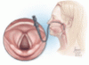 Hoarseness: When to observe and when to refer