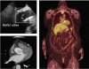 Infective endocarditis: Beyond the usual tests