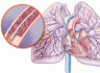 Do patients with submassive pulmonary embolism benefit from thrombolytic therapy?