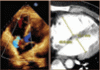 Managing right ventricular failure in the setting of pulmonary embolism