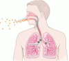 Radon and lung cancer: Assessing and mitigating the risk