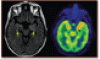 Autoantibody-mediated encephalitis: Not just paraneoplastic, not just limbic, and not untreatable