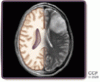 A young woman with Kallmann syndrome and acute neurologic symptoms