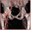 Nonatherosclerotic limb ischemia: Prompt evaluation and diagnosis