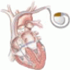 Pacing in heart failure: The benefit of resynchronization