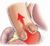 When does asymptomatic aortic stenosis warrant surgery? Assessment techniques