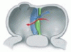 When and how to fix a ‘hole in the heart’: Approach to ASD and PFO