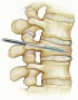 Vertebral compression fractures: Manage aggressively to prevent sequelae