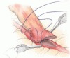 CABG: When, why, and how?
