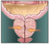 Benign prostatic hyperplasia: Evaluation and medical management in primary care