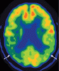 Alzheimer disease: Time to improve its diagnosis and treatment