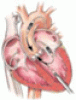 Percutaneous treatment of aortic valve stenosis